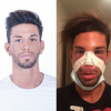 Sacha Buyse (Secret Story 8) : Victime d'oedèmes post-op après une rhinoplastie, il déprime !