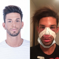 Sacha Buyse (Secret Story 8) : Méconnaissable après une rhinoplastie, il déprime