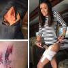 Nina Dobrev affiche ses blessures sur Instagram. Avril 2016