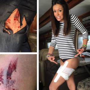 Nina Dobrev affiche ses blessures sur Instagram. Avril 2016