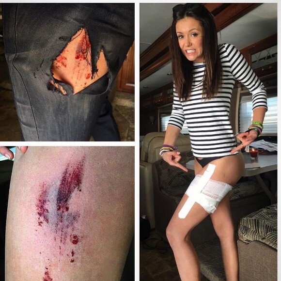 Nina Dobrev affiche ses blessures sur Instagram. Avril 2016