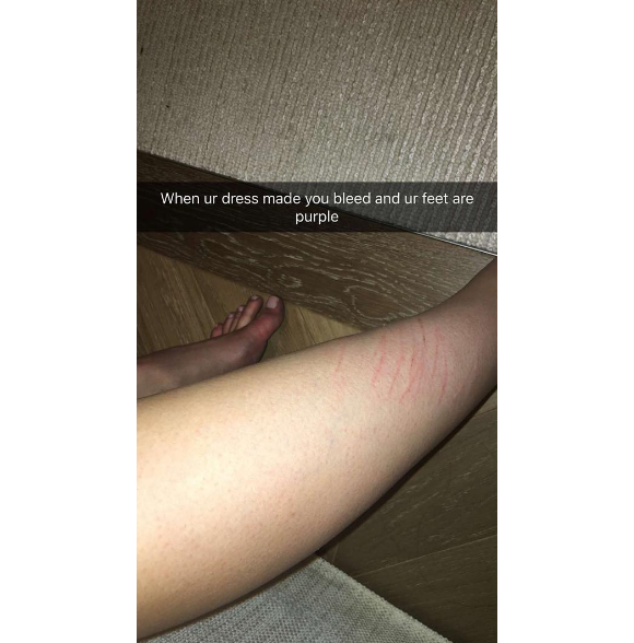 Sur son compte Snapchat, Kylie Jenner a publié une photo de ses jambes et pieds abîmés après la soirée du MET gala, le 2 mai 2016.