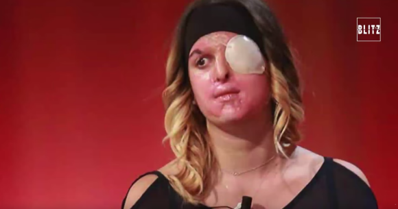 Gessica Notaro, attaquée à l'acide par son ex-compagnon en janvier dernier, dévoile son visage quelques mois après son agression dans une émission de télé italienne - Image extraite d'une vidéo publiée sur Youtube le 21 avril 2017