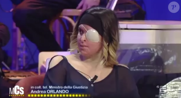 Gessica Notaro, attaquée à l'acide par son ex-compagnon en janvier dernier, dévoile son visage quelques mois après son agression dans une émission de télé italienne - Image extraite d'une vidéo publiée sur Youtube le 21 avril 2017