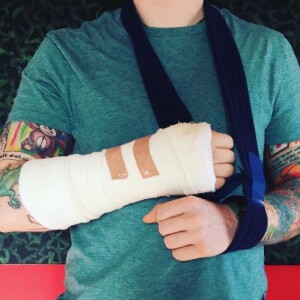 Ed Sheeran le bras cassé après avoir été renversé par une voiture à Londres alors qu'il circualit à vélo. Instagral, le 16 octobre 2017.