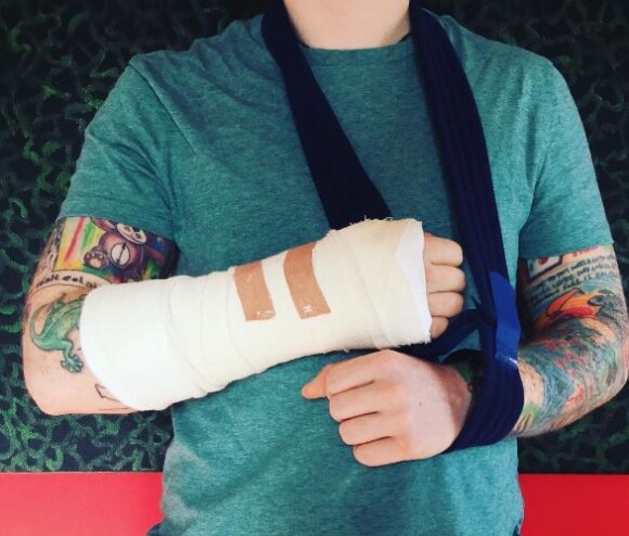 Ed Sheeran le bras cassé après avoir été renversé par une voiture à Londres alors qu'il circualit à vélo. Instagral, le 16 octobre 2017.