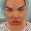 Rodrigo Alves alias "Human Ken Doll" lors d'une opération chirurgicale du visage au centre Medico Beauty & IVF de Prague, République tchèque, le 3 mai 2018.