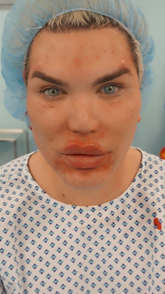 Rodrigo Alves alias "Human Ken Doll" lors d'une opération chirurgicale du visage au centre Medico Beauty & IVF de Prague, République tchèque, le 3 mai 2018.