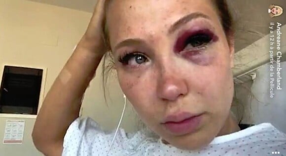 Andréane (Les Vacances des Anges 3) victime d'un accident de buggy sur le tournage - SnapChat, 4 septembre 2018