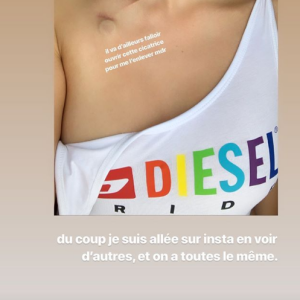 Agathe Auproux répond à une internaute qui se questionne sur sa cicatrice, dimanche 30 juin 2019 sur Instagram.