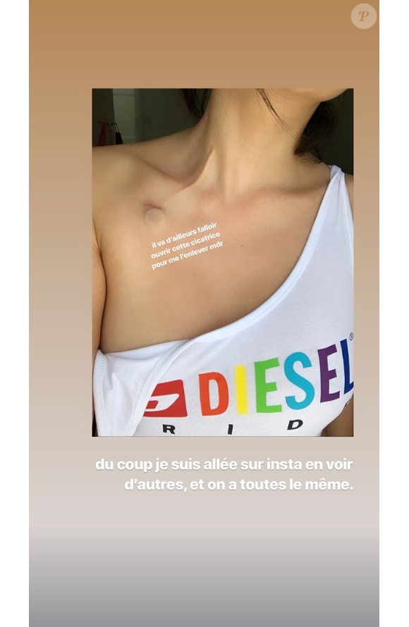Agathe Auproux répond à une internaute qui se questionne sur sa cicatrice, dimanche 30 juin 2019 sur Instagram.