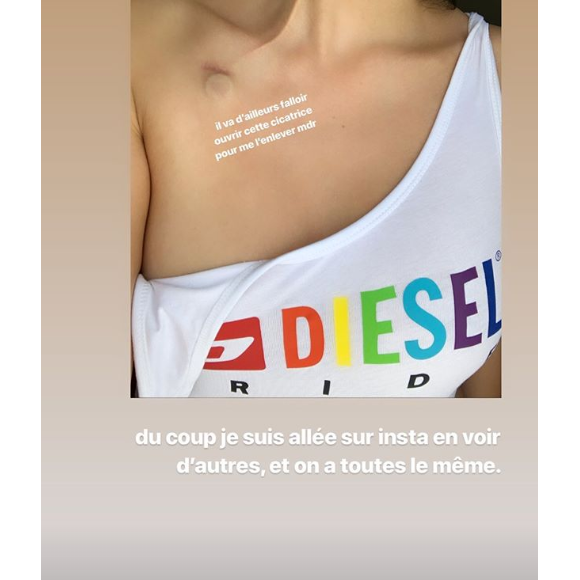 Agathe Auproux répond à une internaute qui se questionne sur sa cicatrice, dimanche 30 juin 2019 sur Instagram.