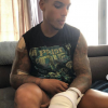 Marvin ("Secret Story 10") a été vicitme d'un accident de scooter. Les photos de ses blessures et de son scooter abîmé sont impressionnantes. Août 2019.