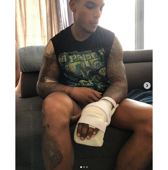 Marvin ("Secret Story 10") a été vicitme d'un accident de scooter. Les photos de ses blessures et de son scooter abîmé sont impressionnantes. Août 2019.