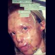  Katie Piper a posté une photo de son visage après son agression à l'acide en 2008. 