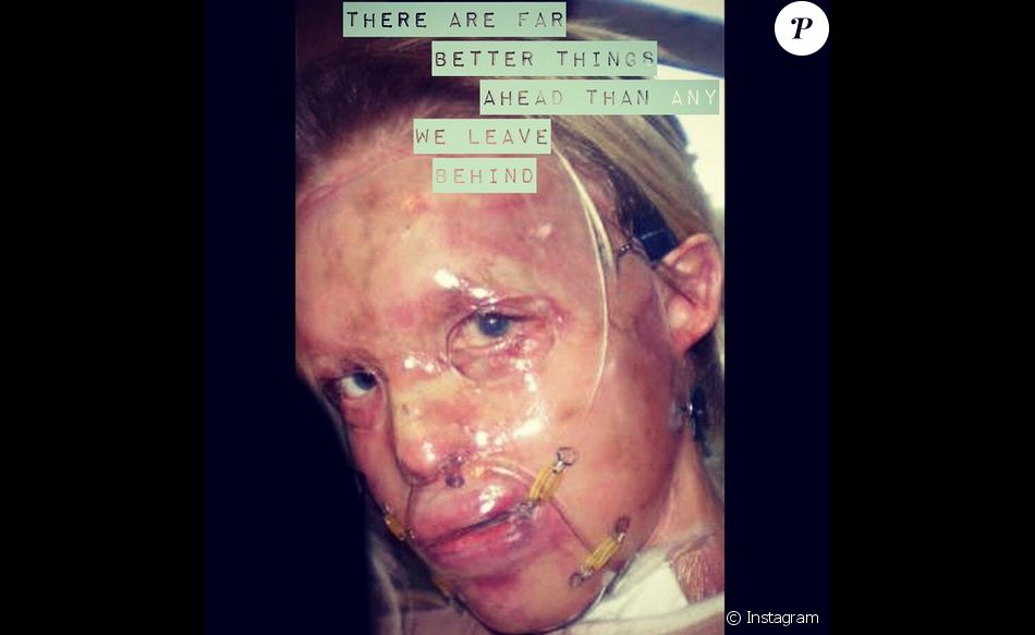  Katie Piper a posté une photo de son visage après son agression à l&#039;acide en 2008. 