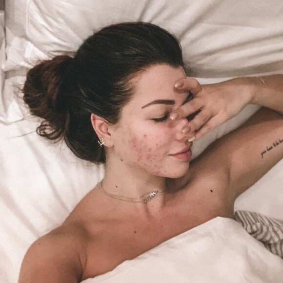 Marie Lopez (EnjoyPhoenix) dévoile et assume son acné, le dimanche 1er mars 2020 sur Instagram.