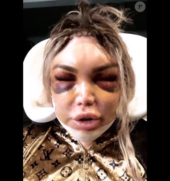 Roddy Alves après une opération pour féminiser les traits de son visage. Instagram. Le 17 février 2020.