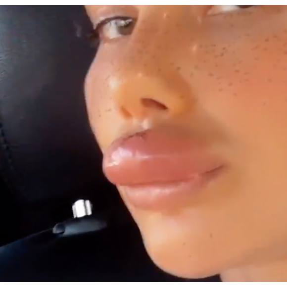 Justin Bieber : son ex Sahara Ray défigurée après une morsure de chien (Instagram).