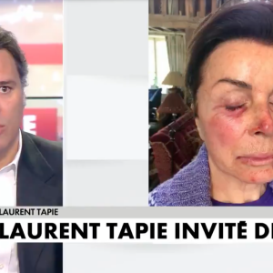 Les visages meurtris de Bernard Tapie et sa femme Dominique après leur agression survenue à leur domicile, en avril 2021.