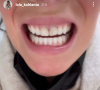 Lola de "Koh-Lanta 2020" va chez le dentiste et dévoile tout à ses abonnés, le 6 mai 2021, sur Instagram
