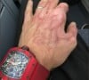 Romain Grosjean dévoile une photo de sa main meurtrie.
