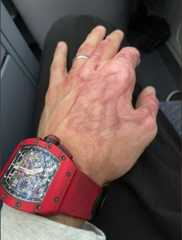 Romain Grosjean dévoile une photo de sa main meurtrie.