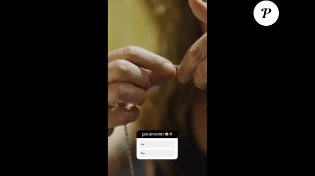 Julien Doré dévoile les conséquences de sa piqûre de guêpe sur Instagram