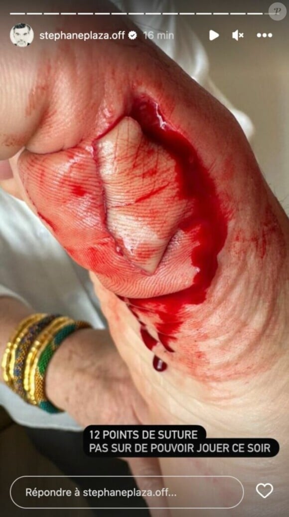 Il a fait savoir qu'il s'était blessé au pied, partageant une photo de celui-ci très abimé et en sang. 
Stéphane Plaza blessé au pied et emmené à l'hôpital après un accident - Instagram