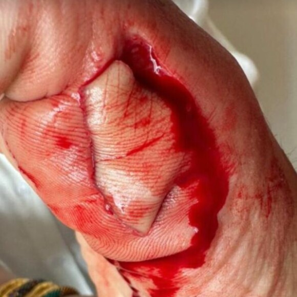 Il a fait savoir qu'il s'était blessé au pied, partageant une photo de celui-ci très abimé et en sang. 
Stéphane Plaza blessé au pied et emmené à l'hôpital après un accident - Instagram