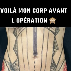 Manon Marsault a dévoilé son corps avant-chirurgie