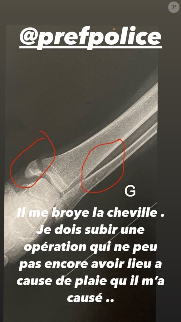 "Il me broie la cheville. Je dois subir une opération qui ne peut pas encore avoir lieu à cause de plaies qu'il m'a causées...", poursuit le compagnon de France Pierron