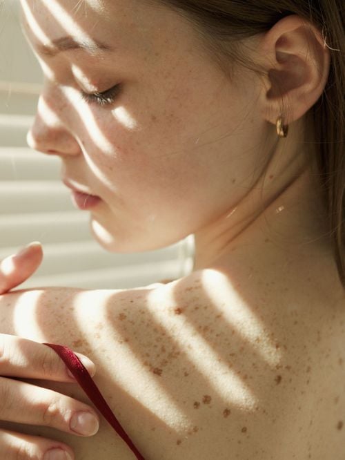 Votre peau pèle après un coup de soleil ? Nos solutions pour éviter l'aspect peau de serpent