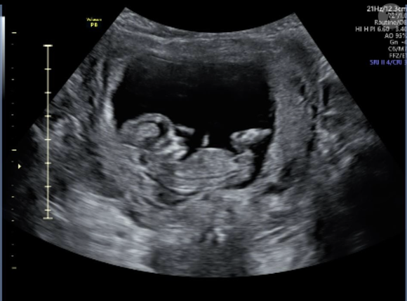 Au terme d'un long processus, il peut confirmer que son bébé devrait bien voir le jour...

Marc Hay a annoncé sur Instagram qu'il va être papa pour la première fois