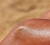 Une dermatologue alerte sur la banalisation des coups de soleil partagés sur les réseaux sociaux.