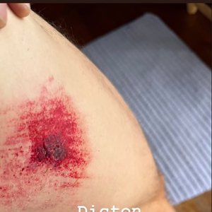 Sur les images, il montre d'une part le haut d'une de ses cuisses, grandement éraflée

Bixente Lizarazu annonce s'être blessé à vélo.