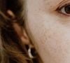 L'été s'achève en laissant souvent sur le visage d'indésirables hyperpigmentations solaires.