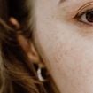 Taches brunes : Pourquoi elles ressortent davantage après l’été et comment les atténuer ?