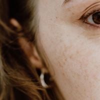 Taches brunes : Pourquoi elles ressortent davantage après l’été et comment les atténuer ?