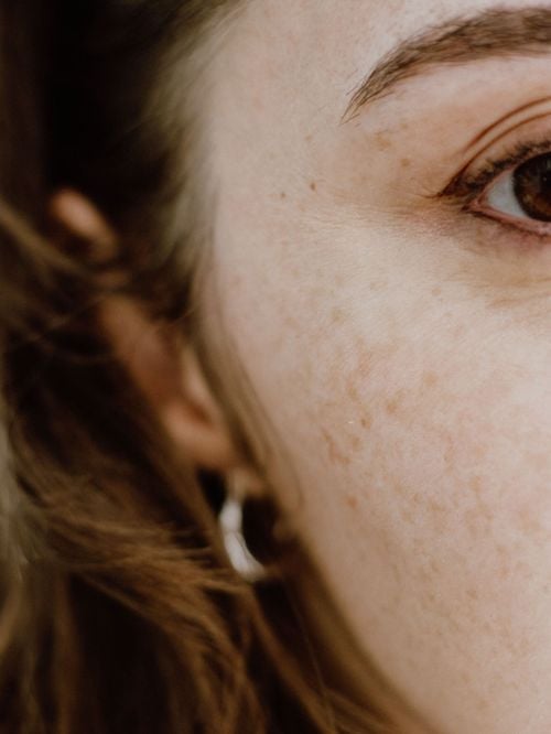 Taches brunes : Pourquoi elles ressortent davantage après l’été et comment les atténuer ?