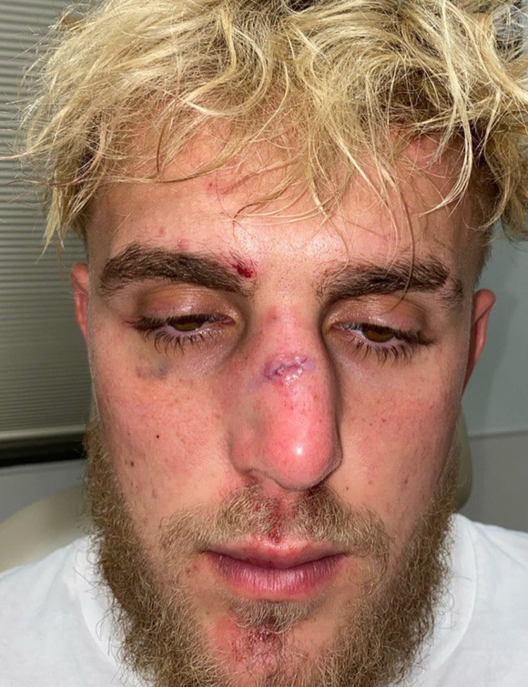 Jake Paul, le nez cassé en novembre 2020.