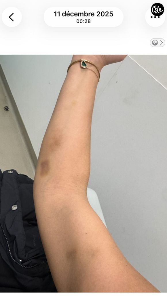 Souailla, la femme de Jimmy Mohamed, partage des images de ses bras couverts de bleus.