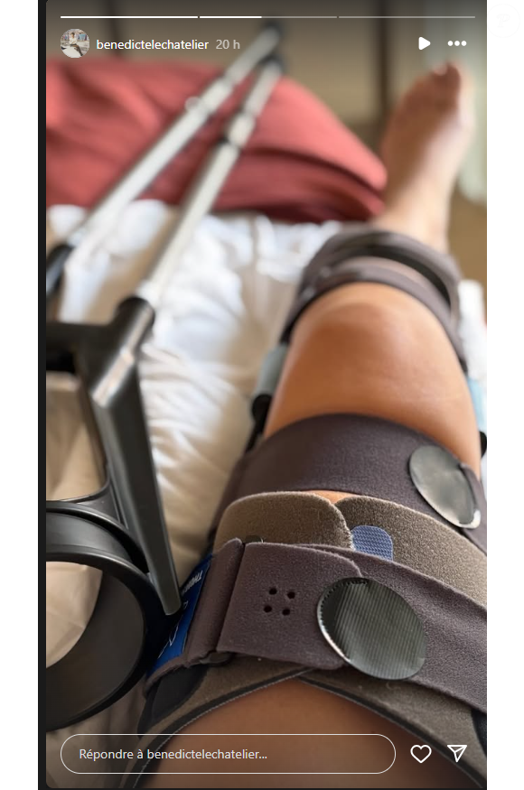 Elle a dévoilé des photos de sa jambe blessée le 17 février 2025
Bénédicte Le Chatelier a été victime d'un accident de ski