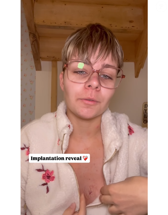"On m'a implanté un Reveal, c'est un petit moniteur qui enregistre le rythme cardiaque parce que j'ai une maladie cardiaque, j'ai le syndrome du QT long (SQTL)"

Perrine (L'amour est dans le pré) dévoile son implantation cardiaque.