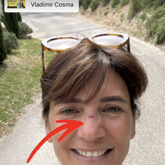 "La porte 1 - Estelle 0", a-t-elle préféré s'en amuser en postant un selfie d'elle en story Instagram.

Estelle Denis se blesse au visage pendant ses vacances avec son compagnon Marc Thiercelin