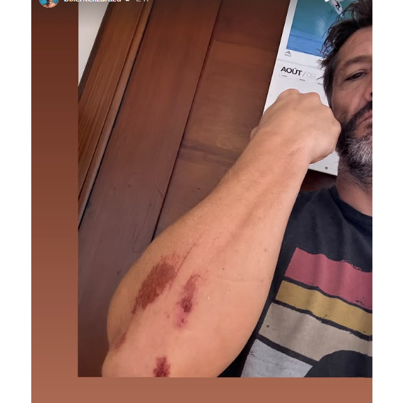 et d'autre part son bras égratigné de manière impressionnante également. 

Bixente Lizarazu annonce s'être blessé à vélo.