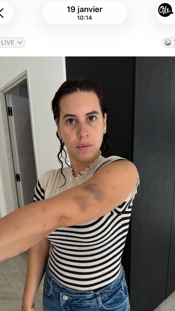Souailla, la femme de Jimmy Mohamed, partage des images de ses bras couverts de bleus.