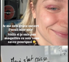 Maïa de la "Star Academy" dévoile sa blessure à l'oeil en story Instagram, le 8 mai 2025