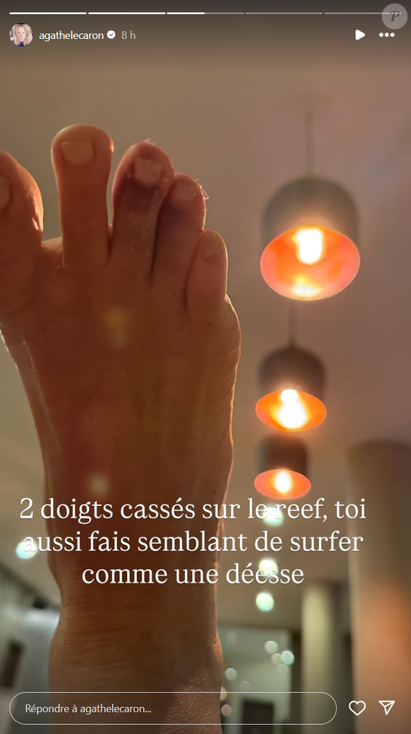 Agathe Lecaron dévoile sa blessure après avoir fait du surf en Amérique du Sud le 9 août 2025 © Instagram
