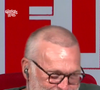 Seule une petite couronne de cheveux le recouvrait ce qui a suscité quelques interrogations de la part des internautes. 

Laurent Ruquier sur RTL pour présenter "Les Grosses têtes"